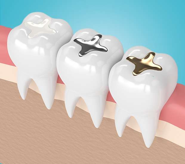 Northvale Composite Fillings