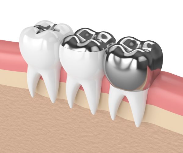 Pros And Cons Of Porcelain Crowns