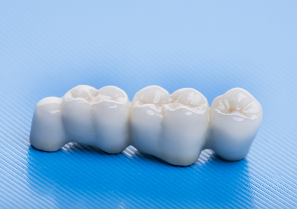 Consider A Dental Bridge To Replace Missing Teeth