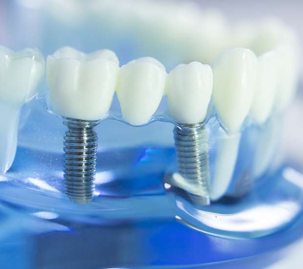 Northvale Dental Implants