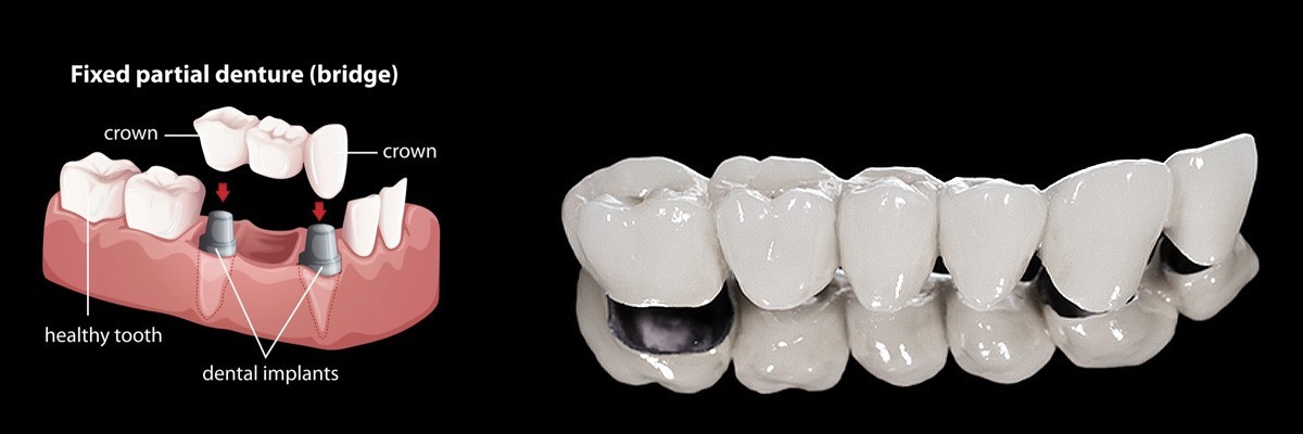 Northvale Dentures