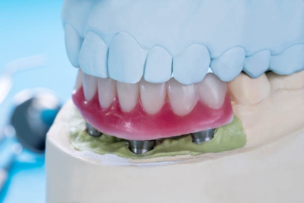 Implant Supported Dentures Vs  Conventional