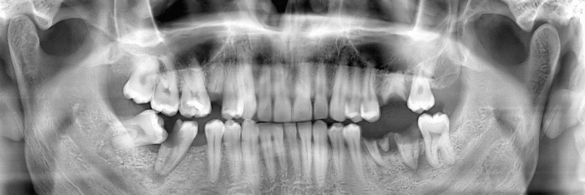 Northvale Wisdom Teeth Extraction